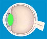 Cataract & Lens Problems